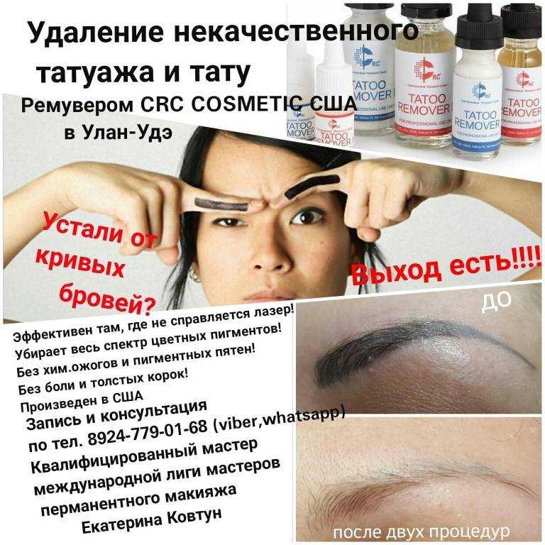 Лазерное удаление татуажа: стоит ли рисковать (2021)