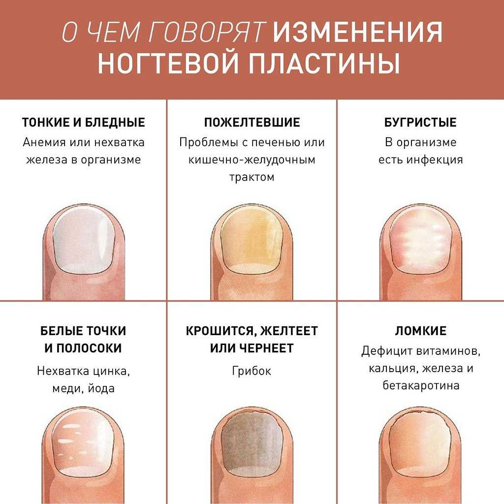 Как восстановить ногти после гель-лака: профессиональные секреты и рецепты народных целителей
