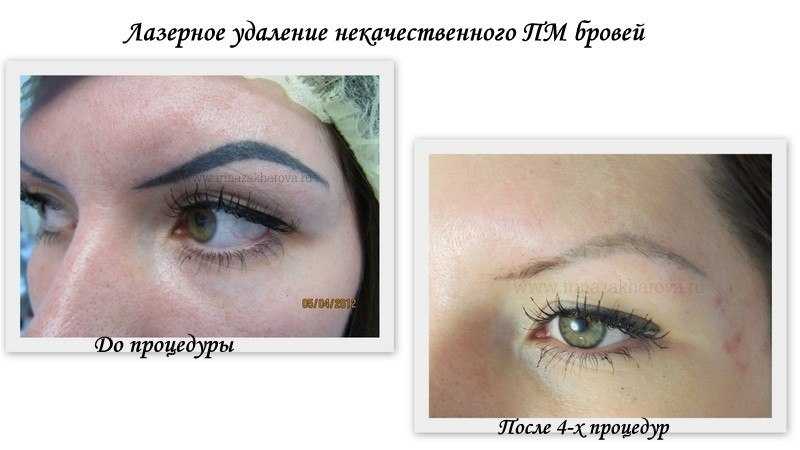 Как происходит удаление татуажа бровей лазером? больно ли делать процедуру?