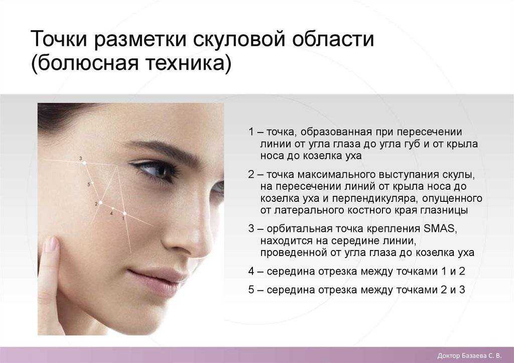 Рейтинг лучших филлеров для скул: выбираем качественный препарат