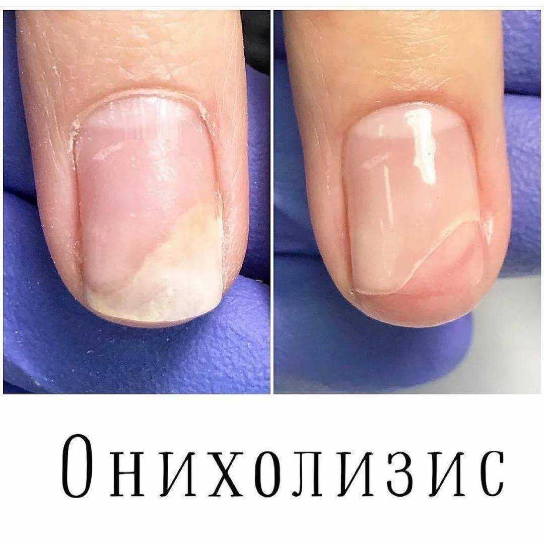 Отошли ногти после гель-лака: выявляем причины
