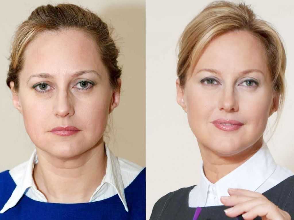 Пластика щек и правка скул- уменьшение и удаление комков биша: фото до и после
