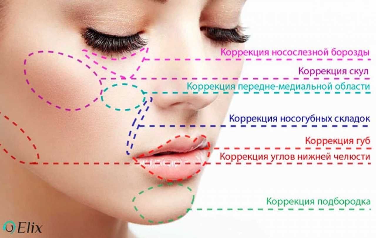 Увеличение объема скул | акриол про