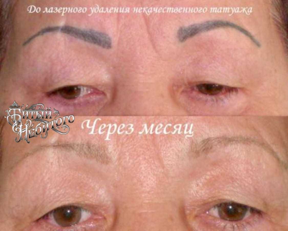 Удаление татуажа бровей лазером с фото до и после: подготовка, уход за кожей лица после удаления перманентного макияжа