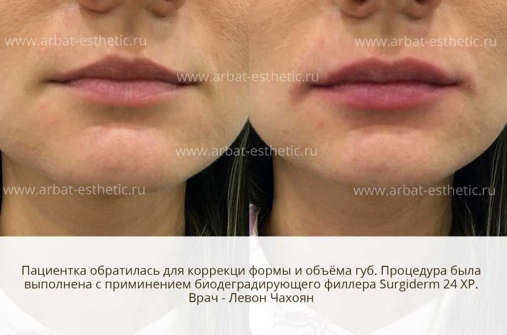 Процедура по увеличения губ техники и результаты. фото - косметология доктора корчагиной