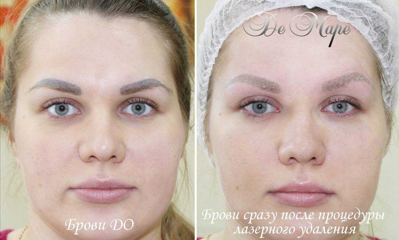 Вредно ли для зрения и кожи век лазерное удаление татуажа?