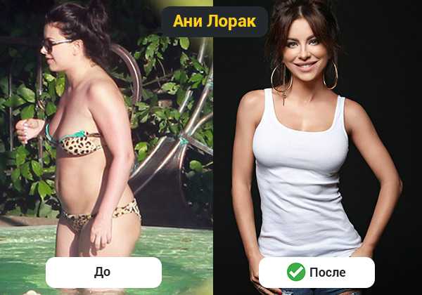 Ани лорак — фотографии до и после пластических операций