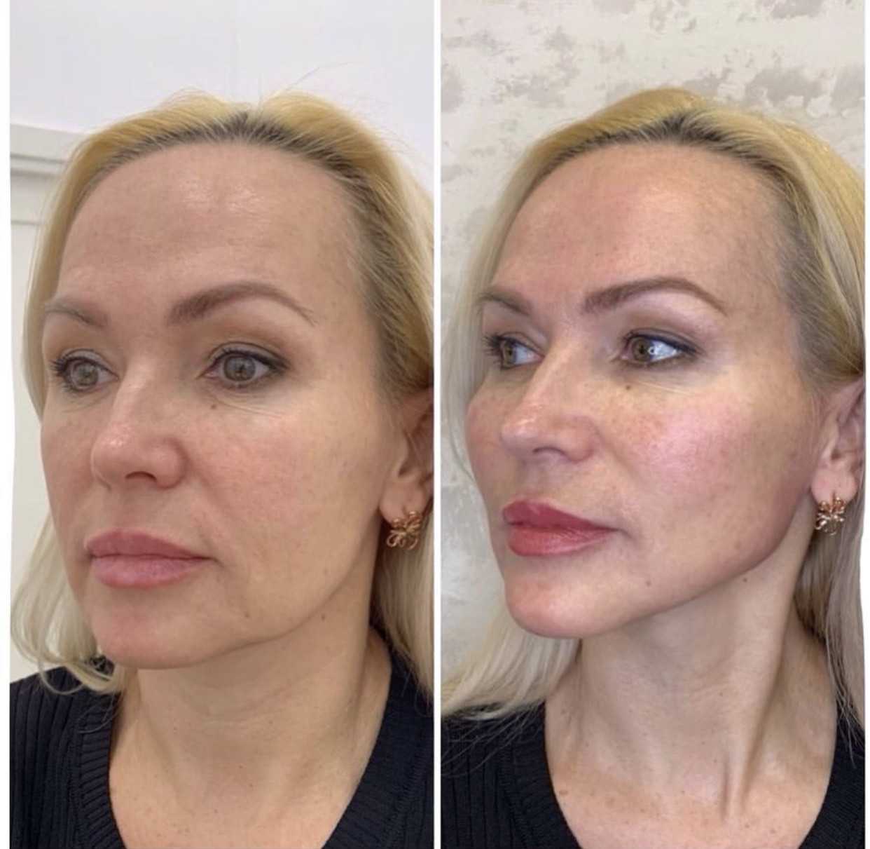 Какой вариант пластики скул будет наиболее эффективным и безопасным?