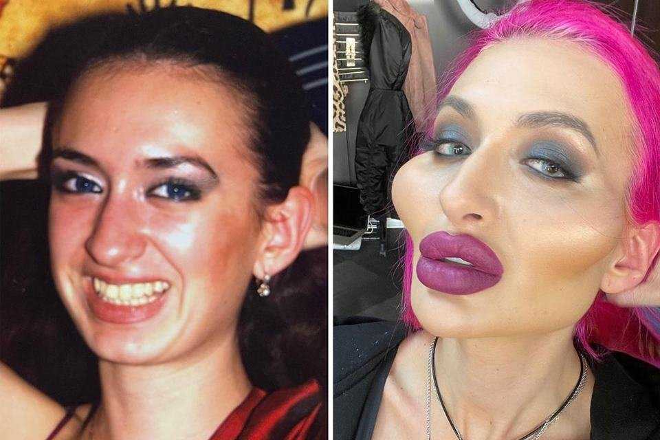 Как выглядит 32-летняя украинка, которая перекачала себе скулы
